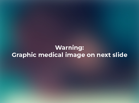 a blurred image with text that reads "Warning: graphic medical image on next slide"