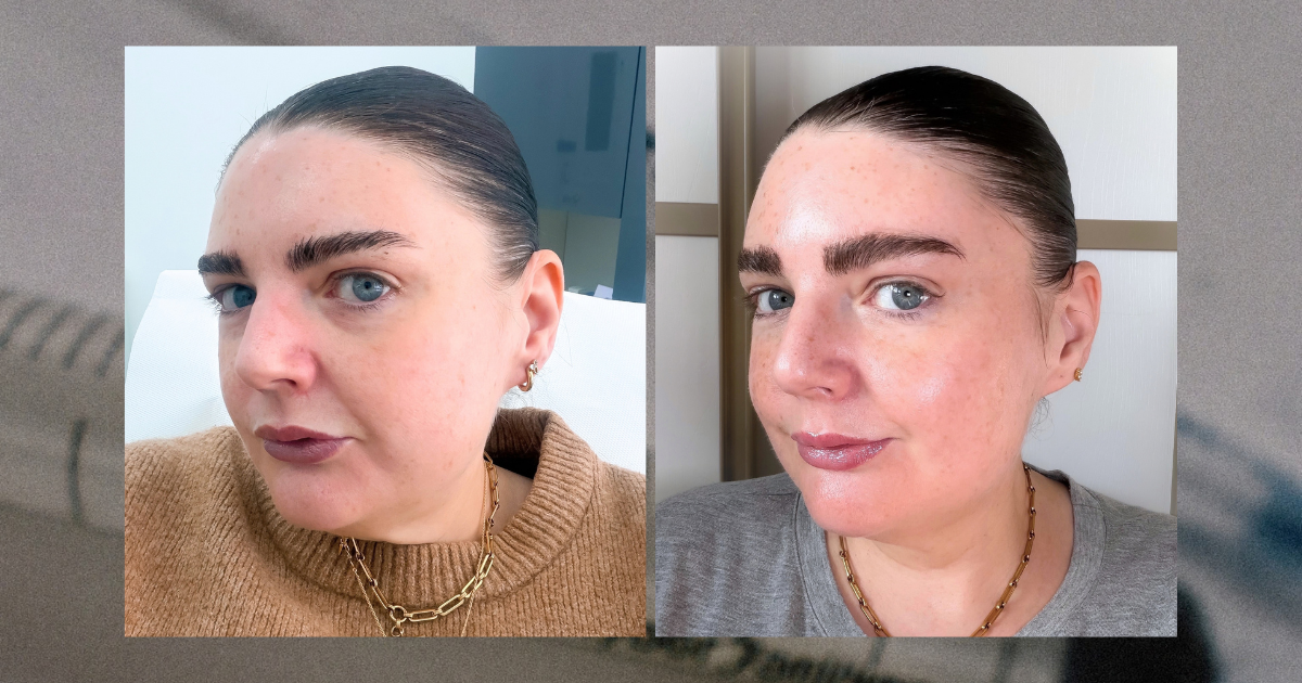 New Photo - I Avoided Injectables Until I Was 42—These Are the 2 Treatments That Changed My Mind