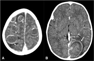A CT scan of the infant's brain showing multiple brain abscesses.