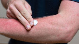 Man applies soothing cream to a sunburn on his arm