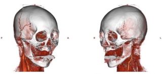 A CT scan of the woman's head several months after the injury shows blood flow in two of the blood vessels on the right side of her head, in the image on the left. That same blood flow is not seen in the image on the right, which shows the left side of her head.