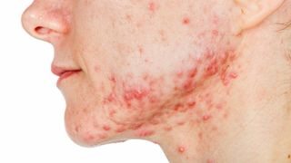 A close-up image of the side profile of a woman's face. She has severe facial acne.