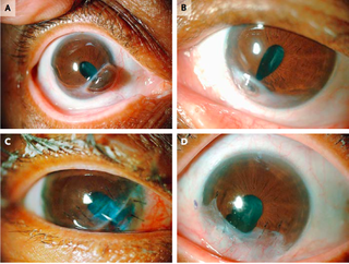 Images A and B show the patient's eyes with corneal melt. The images C and D show the eyes after surgical repair.