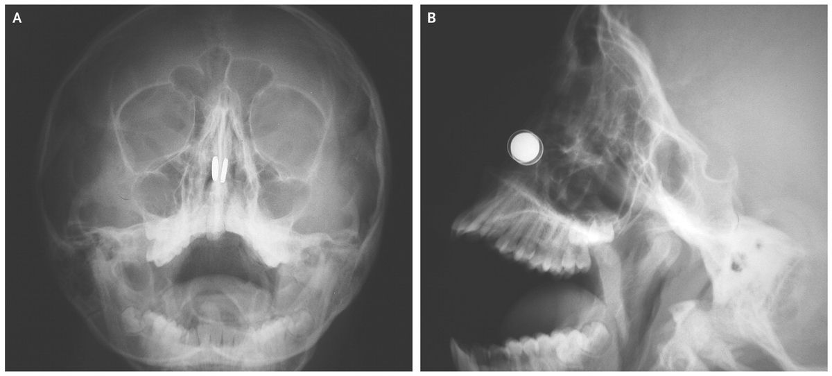 magnets, skull, nejm