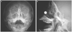magnets, skull, nejm