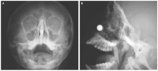 magnets, skull, nejm