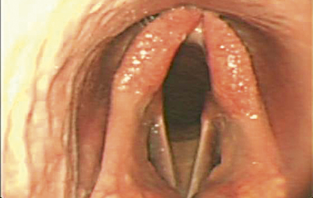 View of a horse's larynx through a videoscope