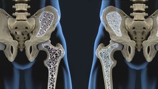 Osteoporotic bone compared to healthy bone