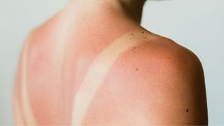 Close-up of sunburn marks on woman's back