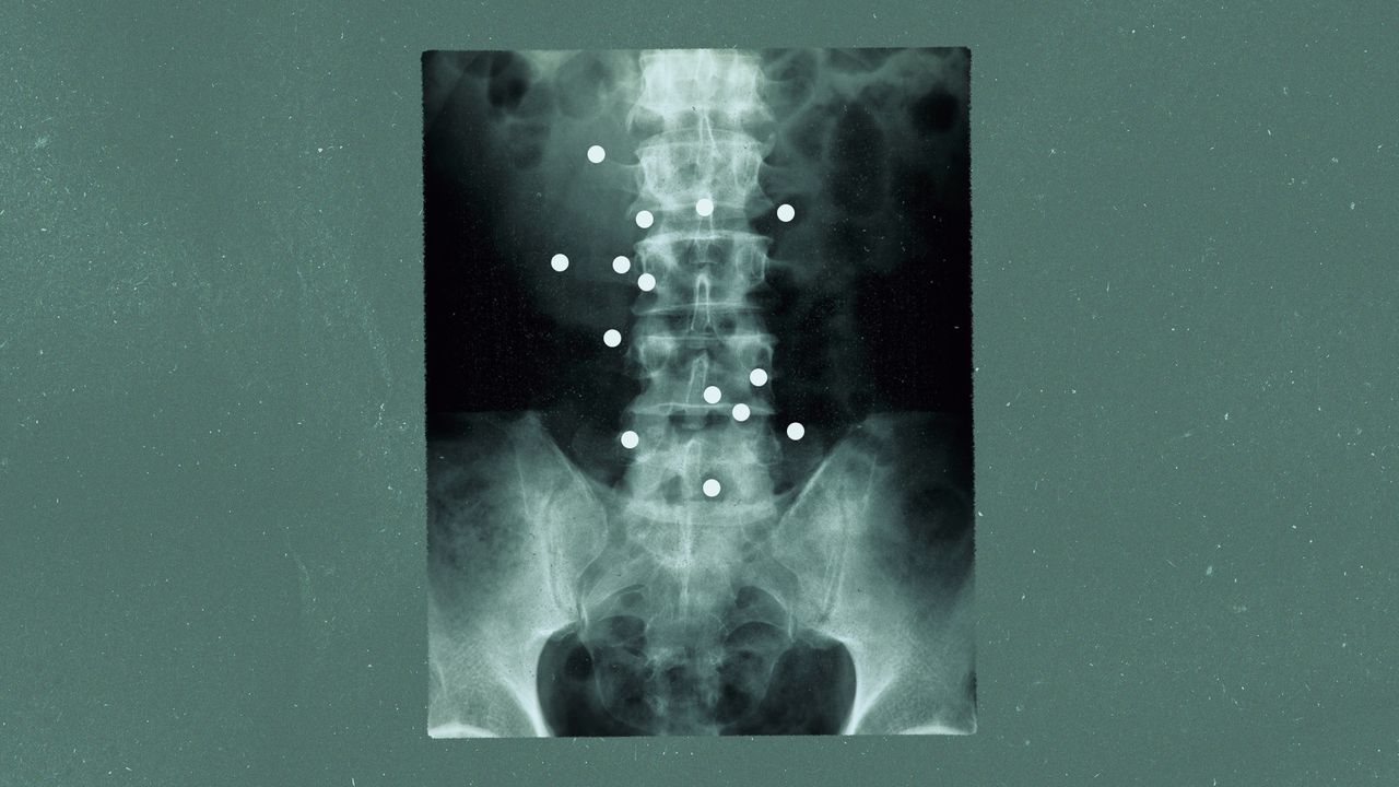 Microrobots that could heal spinal injuries
