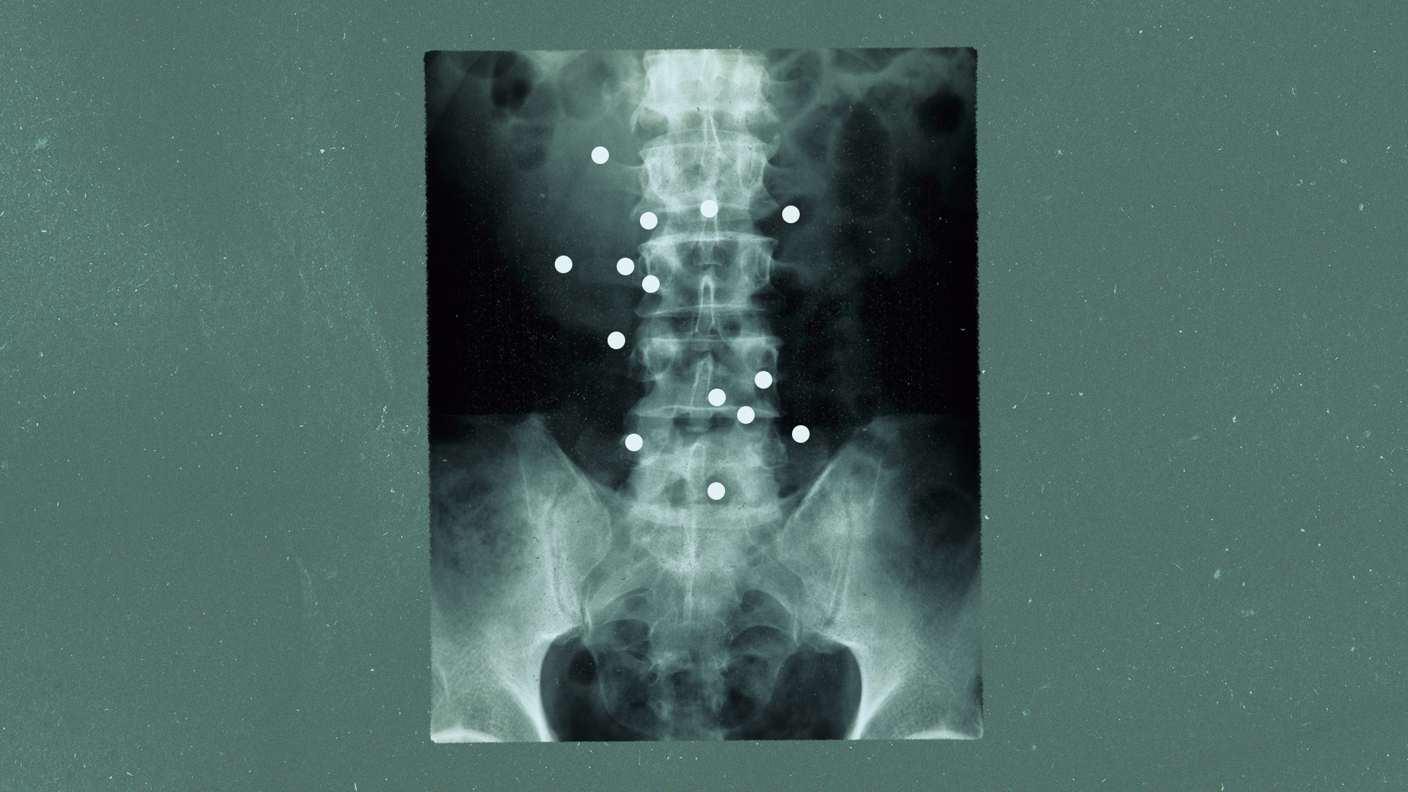 Photo collage of a spine x-ray and tiny dots around it