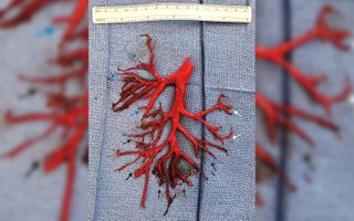 photo shows a large, deep red blood clot shaped like an updside down tree next to a small white ruler