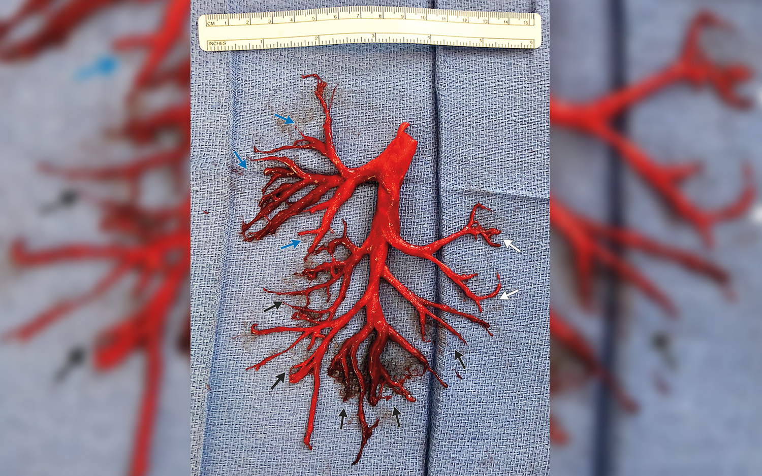 A blood clot formed in the exact shape of a man's lung passage