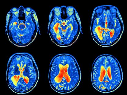 MRI brain scans.