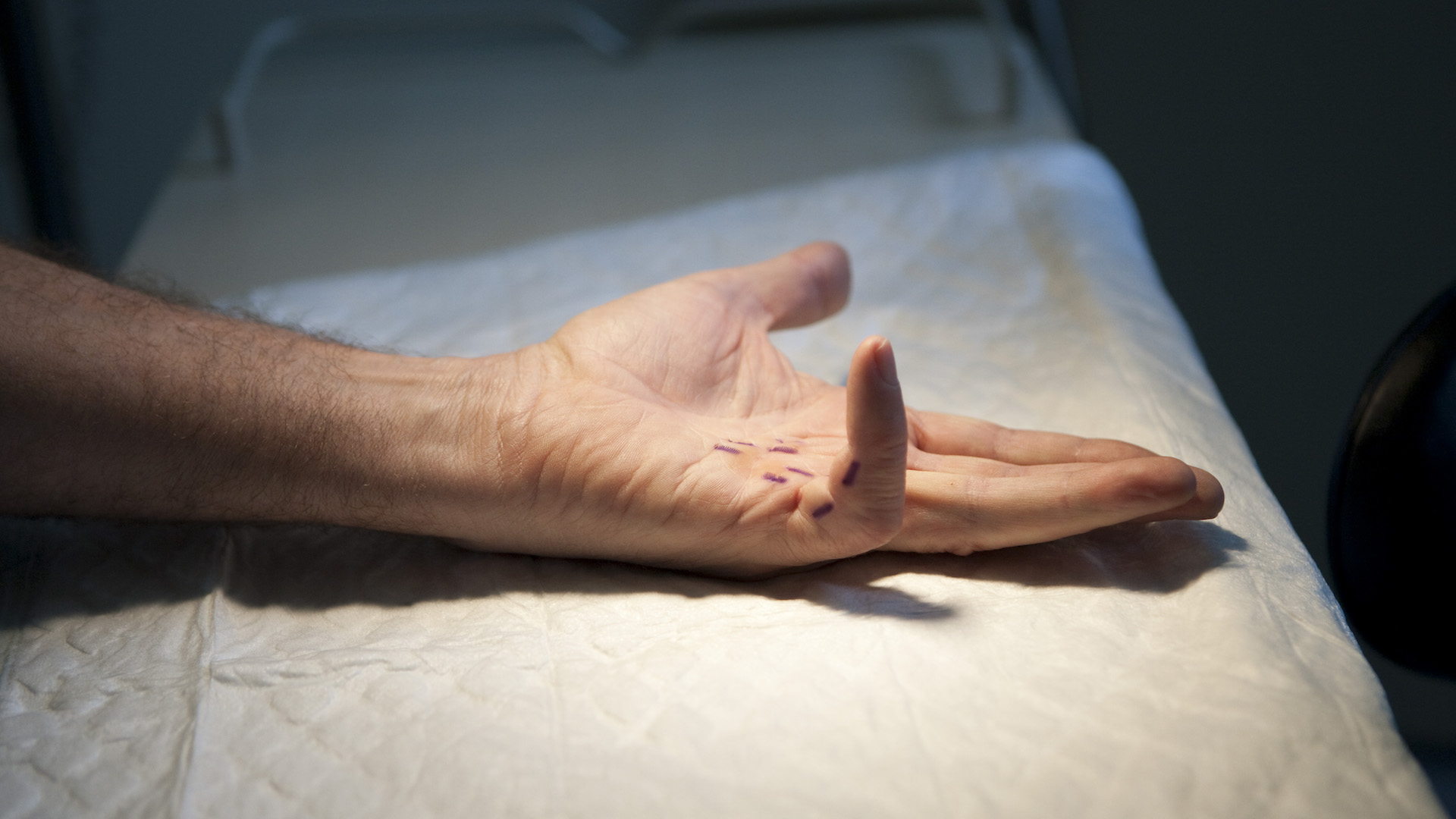 Uma fotografia de uma mão com doença de Dupuytren, causando contração do dedo mínimo.
