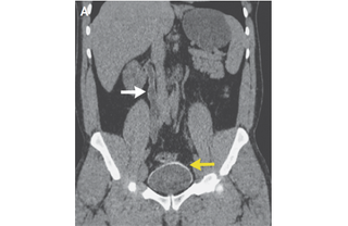 In this CT scan, the white arrow points to the calcification of the man’s bladder, and the yellow arrow indicates the slight calcification of one of his ureters. (The ureters are the tubes that connect the kidneys to the bladder.)