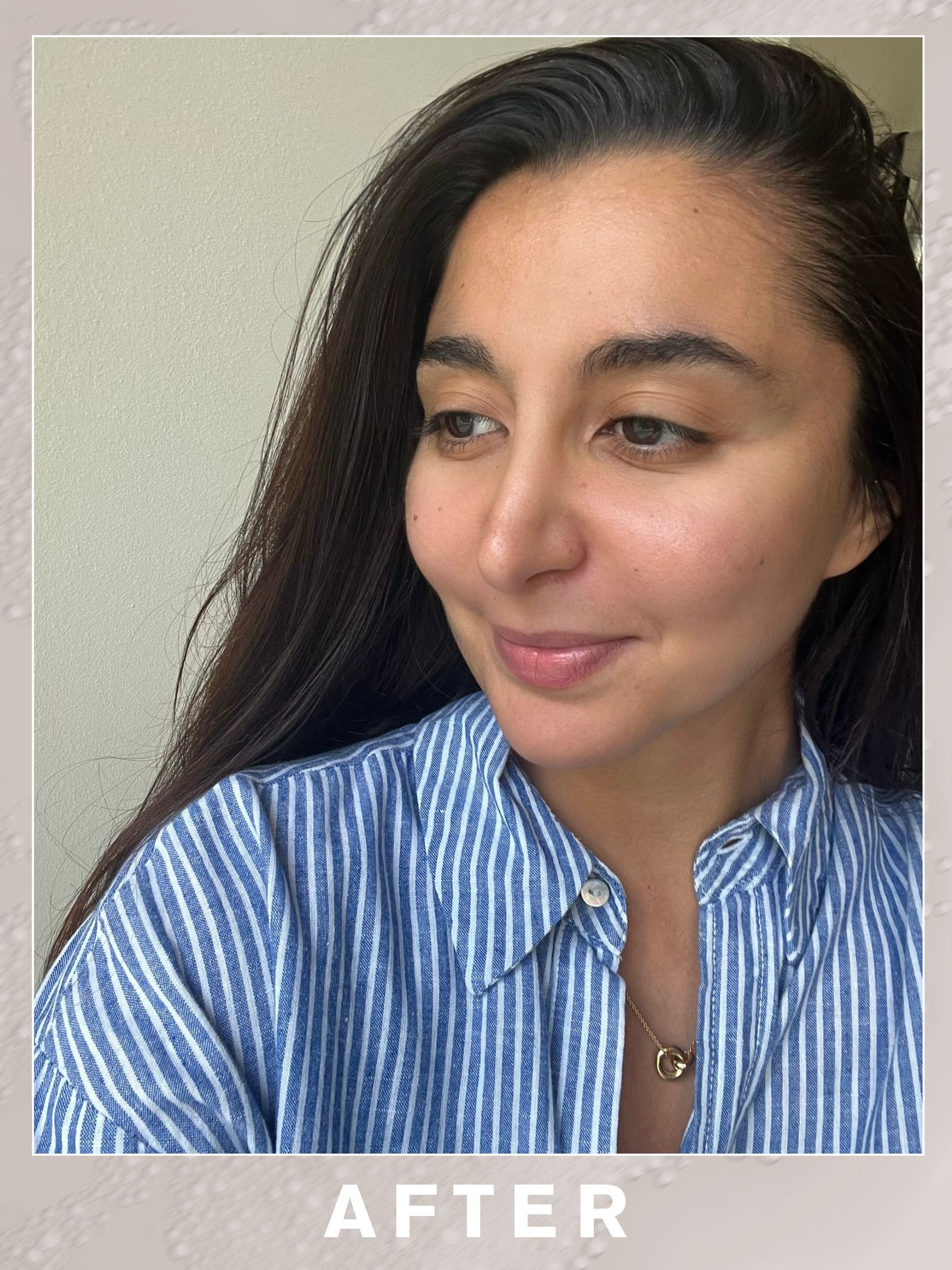 Senior shopping editor Marina Avraam after having nasolabial filler