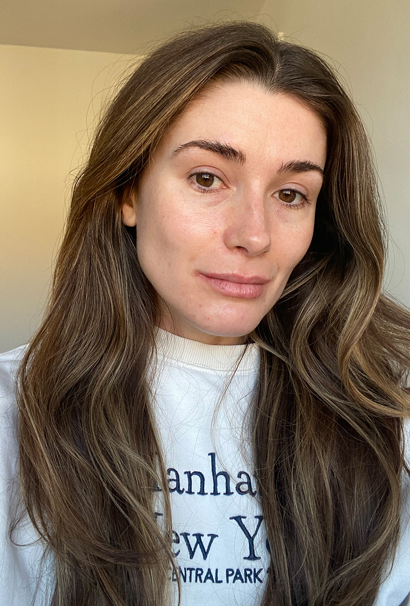Eleanor before using the Dermalux LED Mask