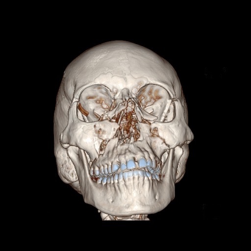 Pic-3-pre-operative-CT.jpg