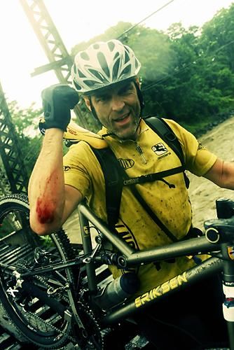 War wounds are always a source of pride for the adventure mountain biker.