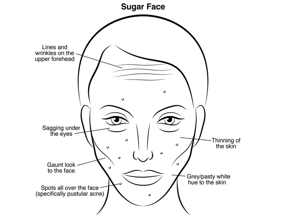 Sugar Face: What Eating A Heavy Sugar Diet Is Doing To Your Skin ...