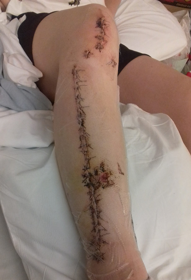 Ryann leg