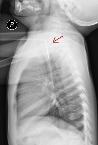 An X-ray shows a lateral view of a SpongeBob pendant in a toddler's throat.