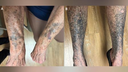 photos of a pale woman's arms and shins showing very dark blotches of hyperpigmentation on both sets of limbs.