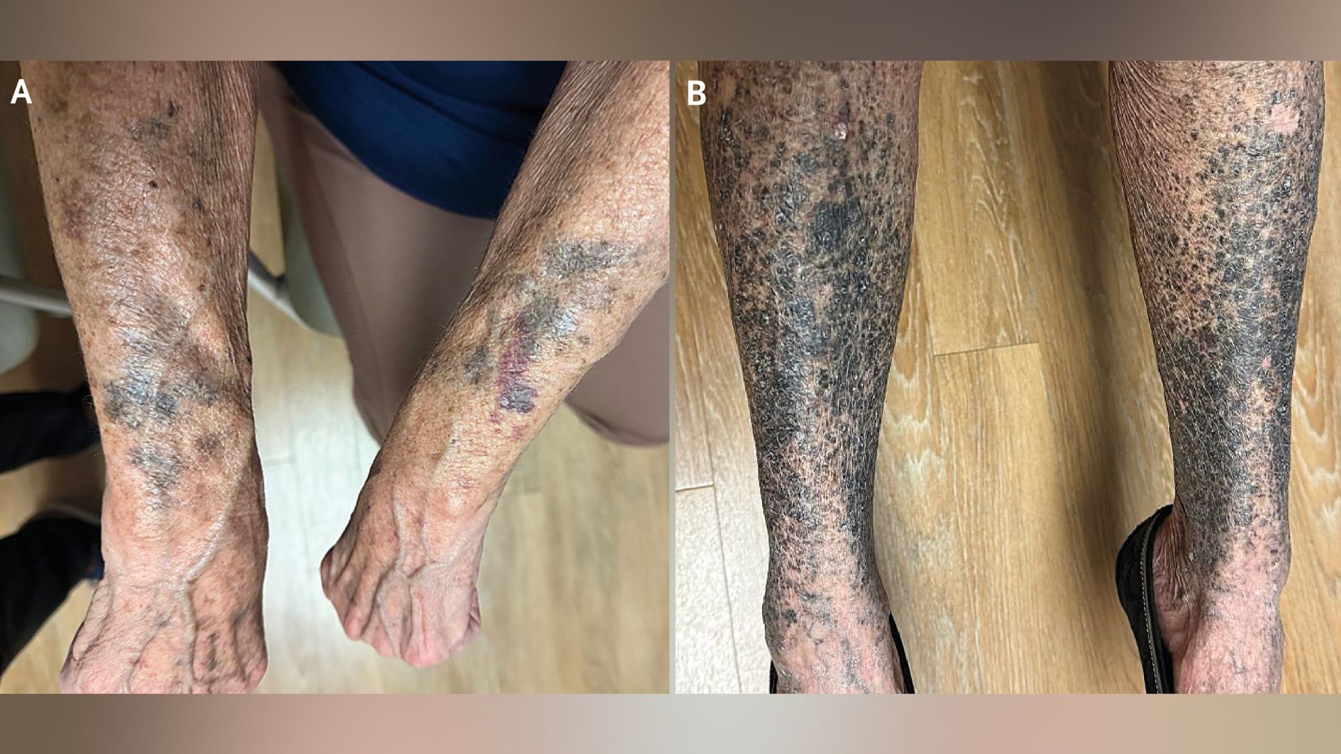 photos of a pale woman's arms and shins showing very dark blotches of hyperpigmentation on both sets of limbs.
