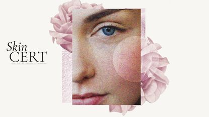 What causes rosacea?