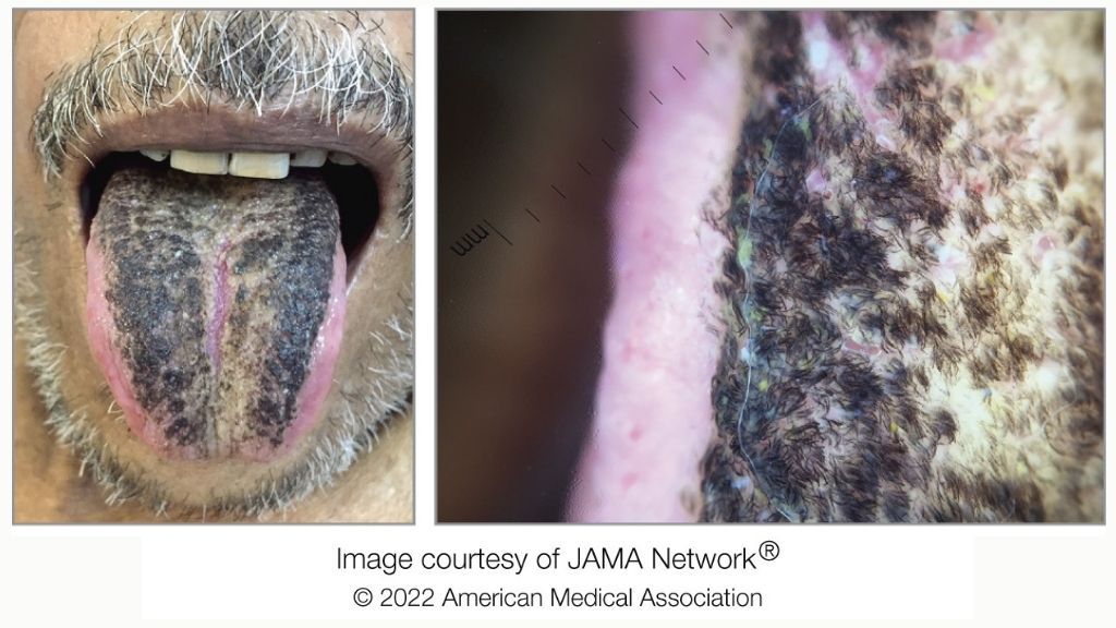 left image shows the bottom half of a man&#039;s face as he sticks out his tongue, which is covered in a thick black coating; the right image shows a close-up of the tongue