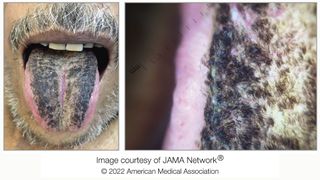 left image shows the bottom half of a man's face as he sticks out his tongue, which is covered in a thick black coating; the right image shows a close-up of the tongue