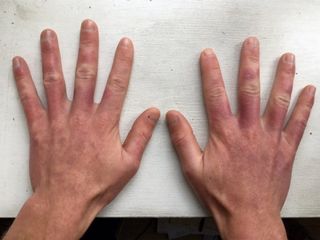 After two months, the man's hands had mostly healed. The residual color on his hands will fade in the coming months, the doctors said, especially if he avoids exposure to sunlight.