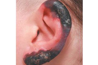 A woman's autoimmune disease caused her to develop skin lesions that look like frostbite. Shown above, a skin lesion on the ear.