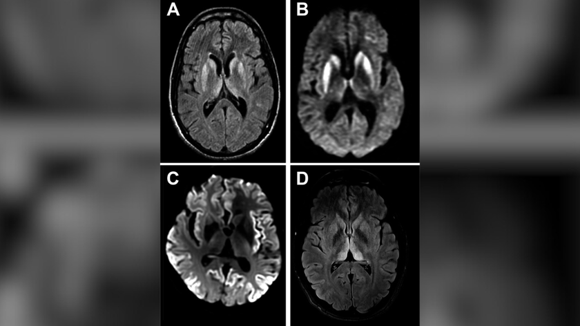 A collage of four MRI brain scans in black and white (two images on top of two others) against a blurred background.