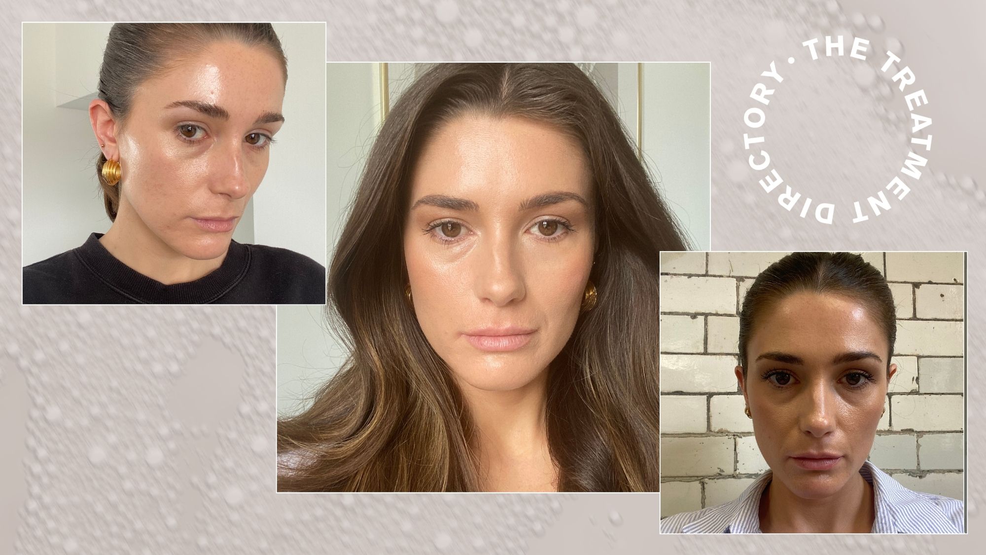A collage of Eleanor after having Botox