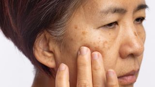 Close up of an older Asian lady's face as she brushed her fingers against her cheeck as she worries about the melasma on face (dark spots of hyperpigmentation).