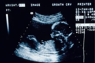 A 12 week ultrasound scan picture used to test the skull theory.