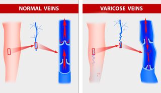 Varicose veins form when faulty valves cause blood to back up and start pooling in the blood vessels.