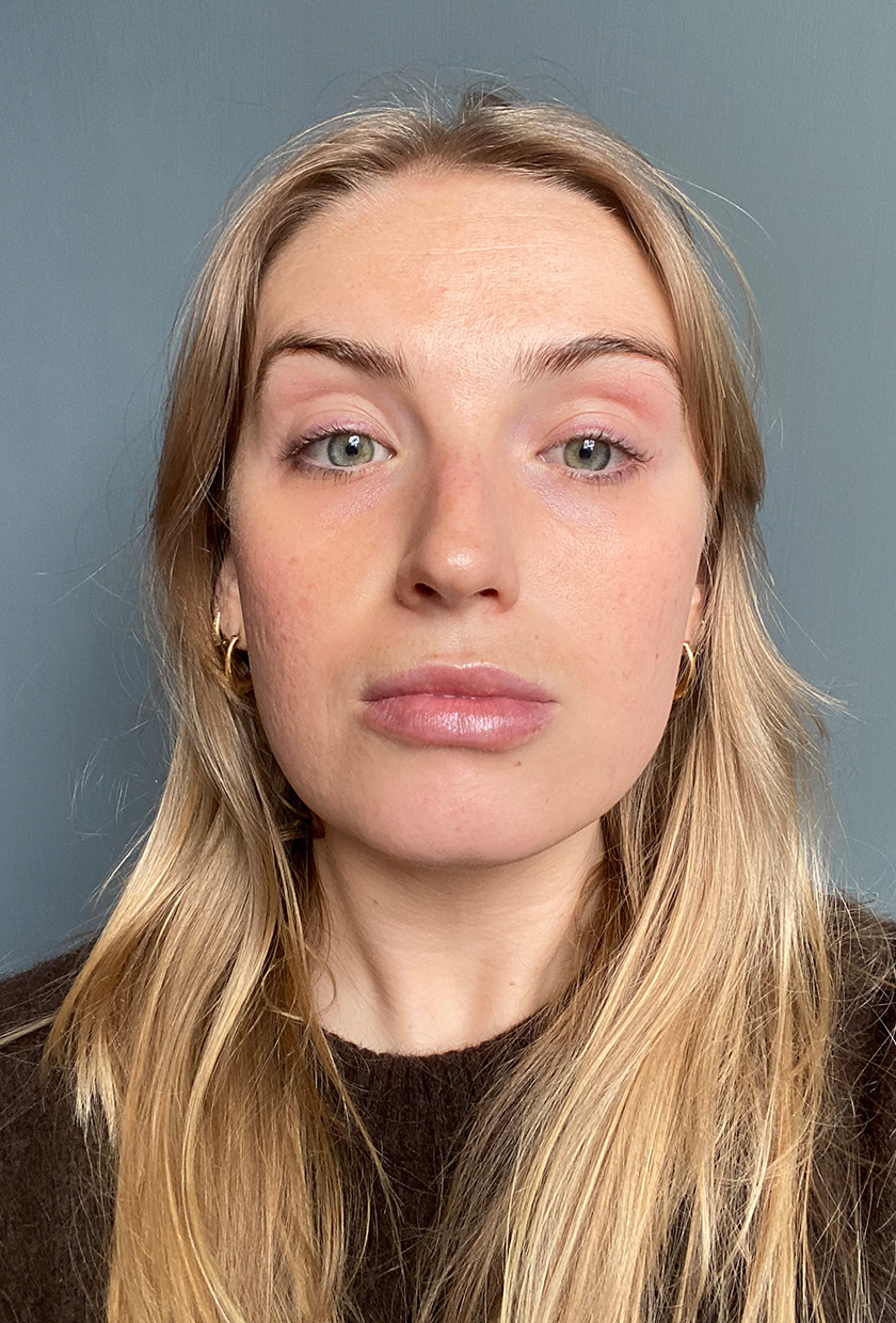 Sophie after using The Light Salon LED Mask