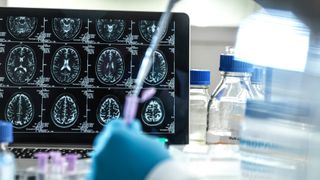 Clinical research to develop a possible cure for Alzheimers and dementia in the lab.