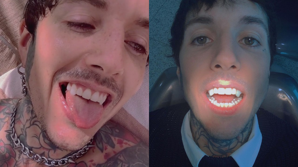 So, Bring Me The Horizon's Oli Sykes has got permanent vampire fangs