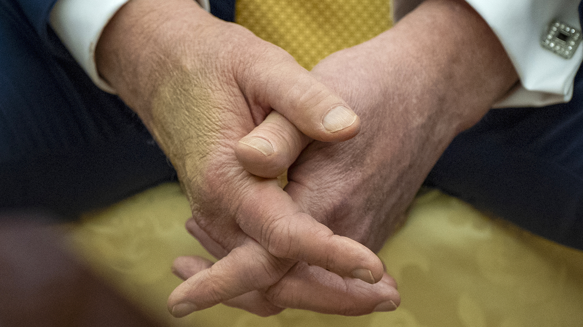 President Donald Trump's swollen, discoloured hands