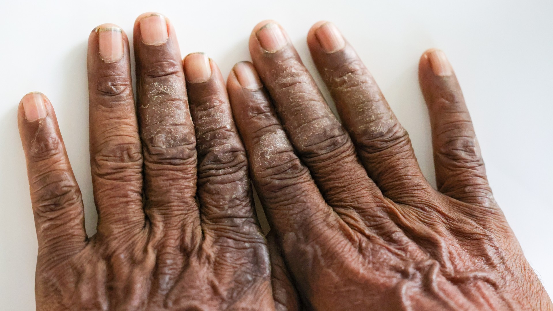 Close up of eczema on the hands of a dark-skinned person