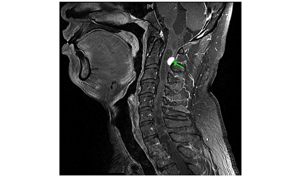 This MRI shows the haemangioblastoma tumor within the man’s neck. 