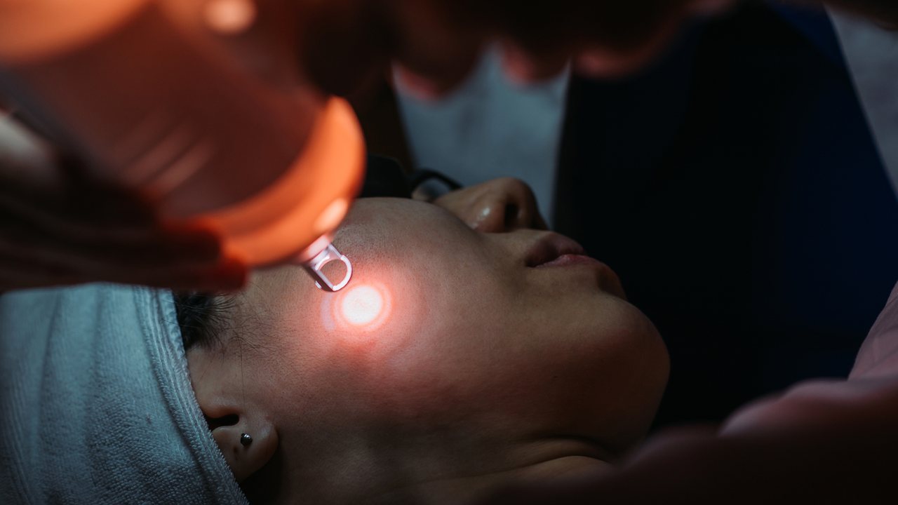 An image of a woman having an in-clinic laser treatment to treat hyperpigmentation - in-clinic hyperpigmentation treatments