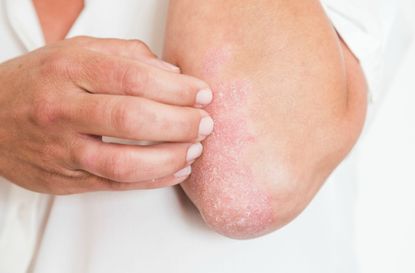 What is psoriasis