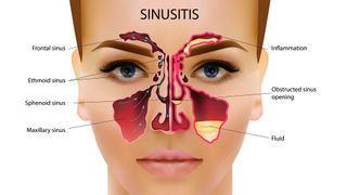 diagram show a human face with cut-away to show healthy sinuses on the left side and red, mucus-filled sinuses on the right