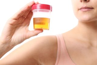 A woman holds a urine sample. 