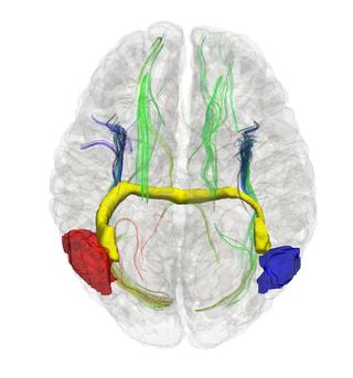 split-brain patient